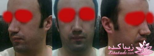 جراحی بینی - جراحی زیبایی